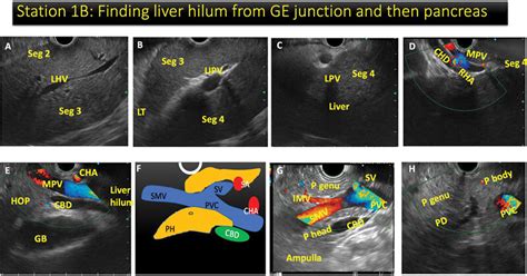 Locating The Pancreas By Identifying The Liver Hilum On Endoscopic Download Scientific Diagram