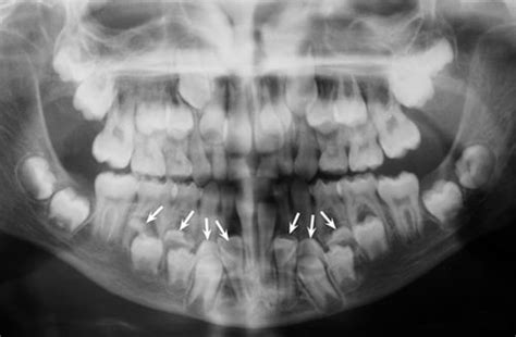 What is a Supernumerary Tooth?