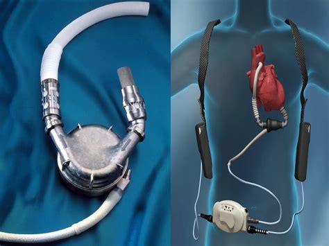 ventricular assist device vad market top leading companies