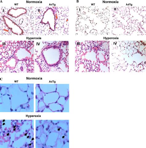 Hyperoxic Lung Injury Is Protected In Adiponectin Overexpressing