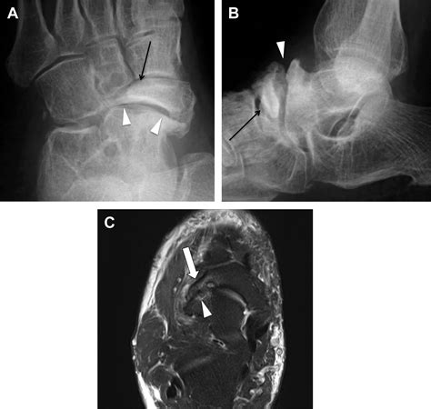 Mr Imaging Of The Midfoot Including Chopart And Lisfranc Joint