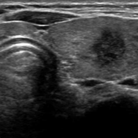 A 59 Year Old Woman With A Papillary Thyroid Carcinoma Showing A