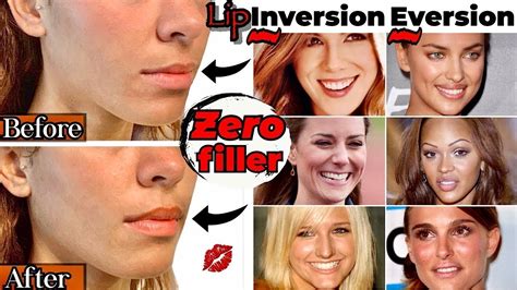 Botox Lip Flip Before And Afters Everything You NEED To Know YouTube