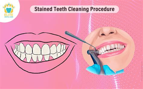 Stained Teeth Cleaning Procedure | Elite Dental Care