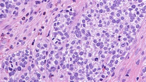 Round Cell Sarcoma With Ewsr Fusion Ottawa Atlas Of Pathology