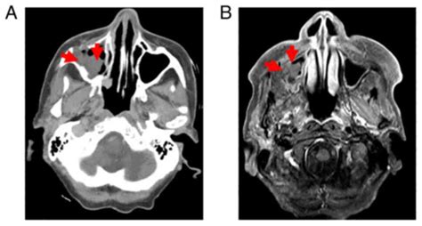 Collision Tumor Of Small Cell Carcinoma And Squamous Cell Carcinoma Of