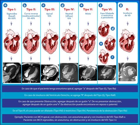 Hypertrophic Cardiomyopathy Proposal For A New Classification