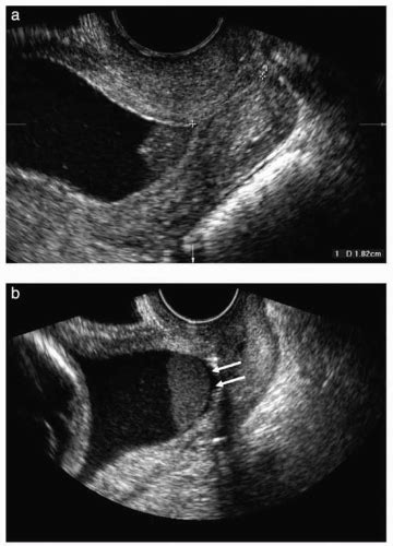 Intra Amniotic Infection Oncohema Key