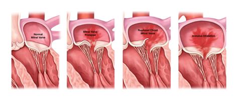 Understanding Mitral Valve Prolapse Ask The Nurse Expert