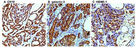 Immunohistochemical CK19 Galetin 3 HBME 1 Staining Of Malignant