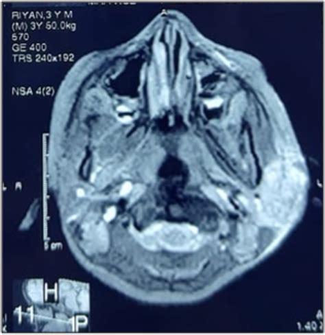 Isolated Parotid Gland Tuberculosis In Pediatric Age Group A Rare Entity