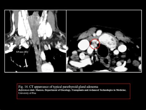 Figure From Imaging Findings Of Parathyroid Lesions In Primary