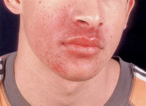 Figure 2 From Papular Purpuric Rash Due To Parvovirus B19 With Distribution On The Distal