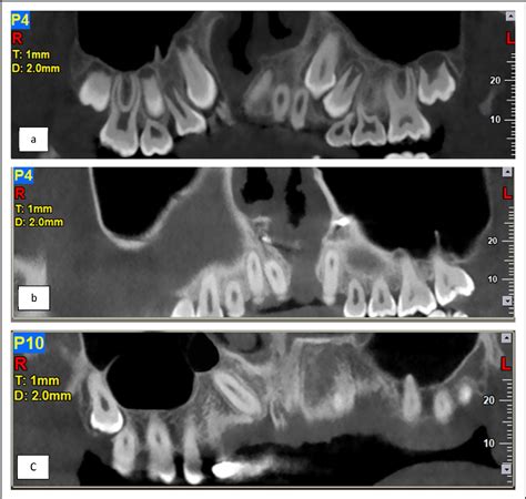 Figure 1 From Prevalence And Features Of Maxillary Sinus Septa In Patients With Cleft Lip And