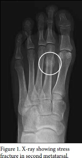 Metatarsal Stress Fracture - Aspen Physiotherapy Services