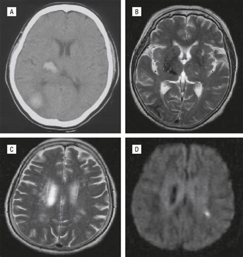 Ipsilateral Hemiparesis Caused By A Corona Radiata Infarct After A