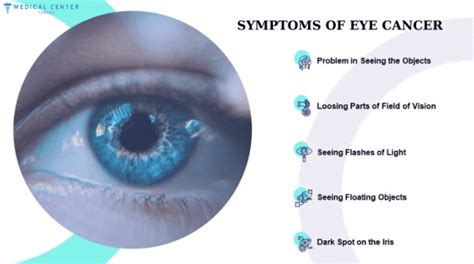 Eye Cancer Mct