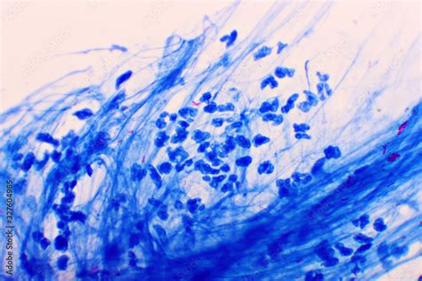 Mycobacterium Tuberculosis Positive Small Red Rod In Sputum Smear Acid Fast Stain Analyze By