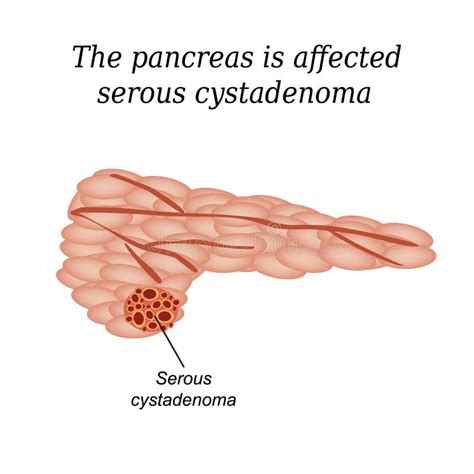 Pancreas Mucous Cystadenoma Adenocarcinoma Stock Vector Illustration