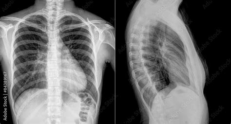 Film Chest X Ray Pa Upright Show Different View