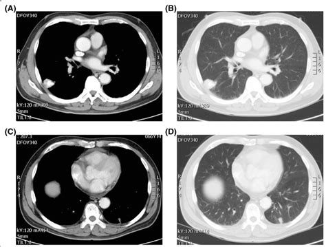 Synchronous Multiple Primary Lung Cancer Of The Year Old Patient