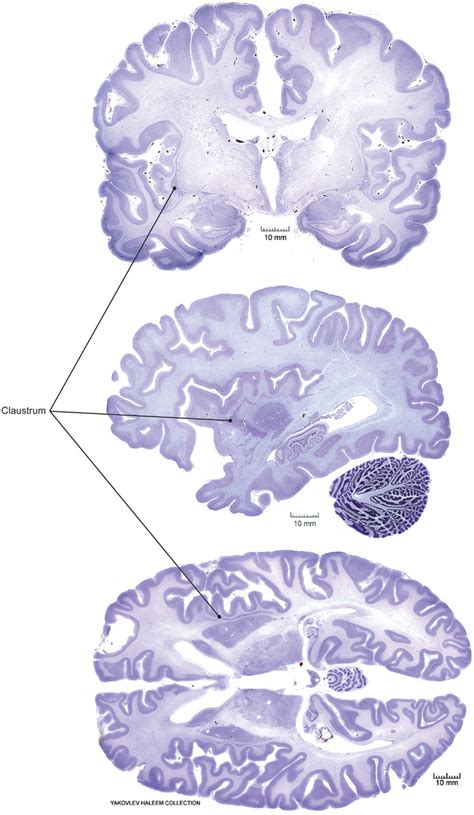 Claustrum location in human brain. Coronal (top), sagittal (middle ...