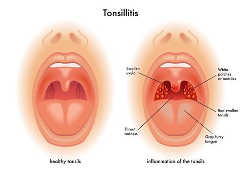 diet affects  tonsils    tonsil stones life