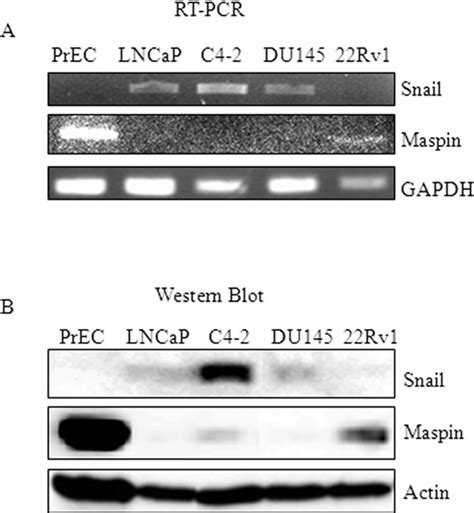 Snail Expression Correlates Inversely With Maspin Expression In Normal Download Scientific