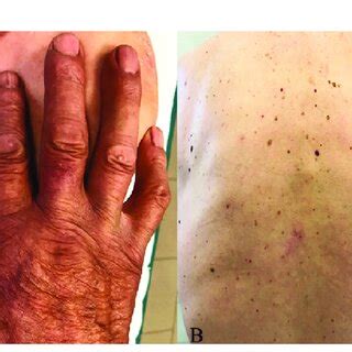 A Complete Resolution Of Skin Lesions With Residual Dyschromia On