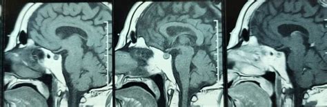 Pituitary Adenoma In A Patient With Conchal Sphenoid Sinus Download