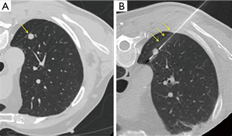 CT Scan Lung Biopsy