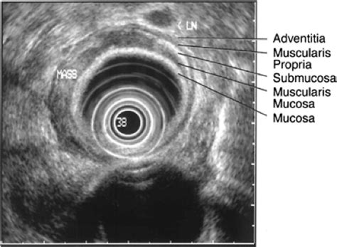 Esophageal Cancer Anatomy And Staging Abdominal Key