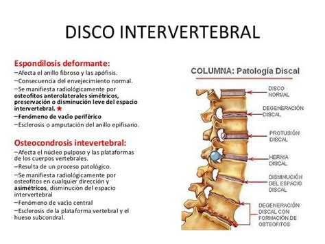 Enfermedad Degenerativa En Columna Lumbar Bobby Pins Hair