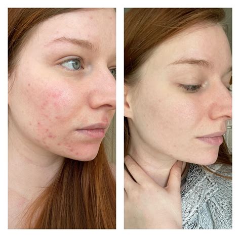 Benzoyl Peroxide Results