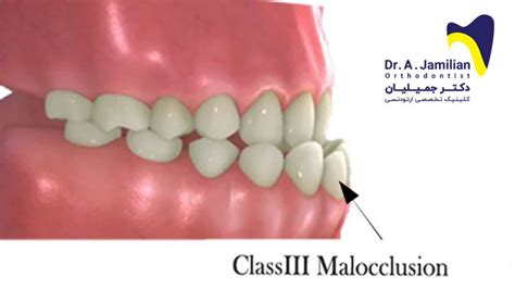 Class III Skeletal Malocclusion Dr Jamilian