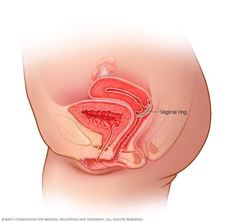 Weight Nuvaring Side Effects