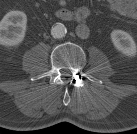 Artifacts In Ct Recognition And Avoidance Radiographics