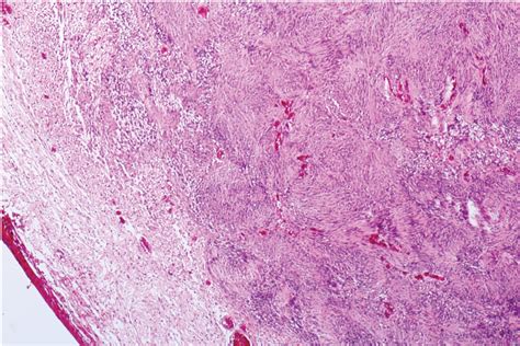 Patient S Histopathology Encapsulated Biphasic Spindle Cell Neoplasm