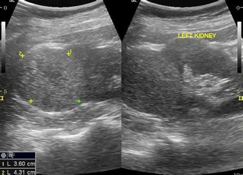 Rcc Ultrasound