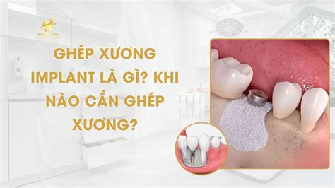 Gh P X Ng Implant L G Khi N O C N Gh P X Ng Nha Khoa Sq Dentist