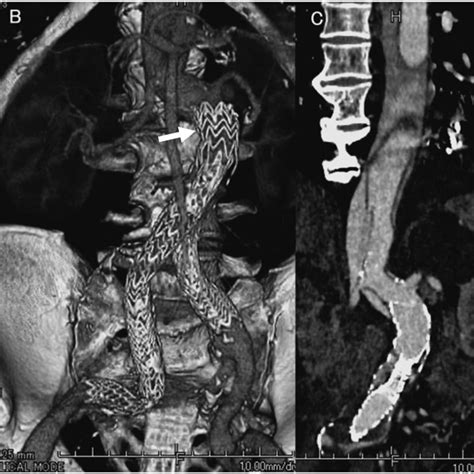 A Preoperative Three Dimensional Computed Tomography Angiogram