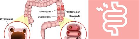 Diverticulitis Que Es Causas Síntomas Y Tratamientos