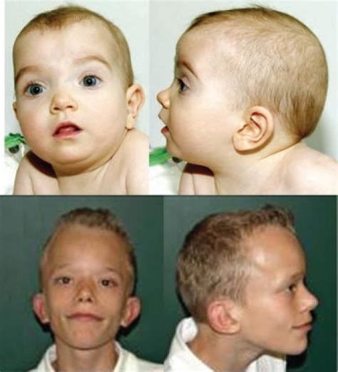 The Face Of Noonan Syndrome Does Phenotype Predict Genotype