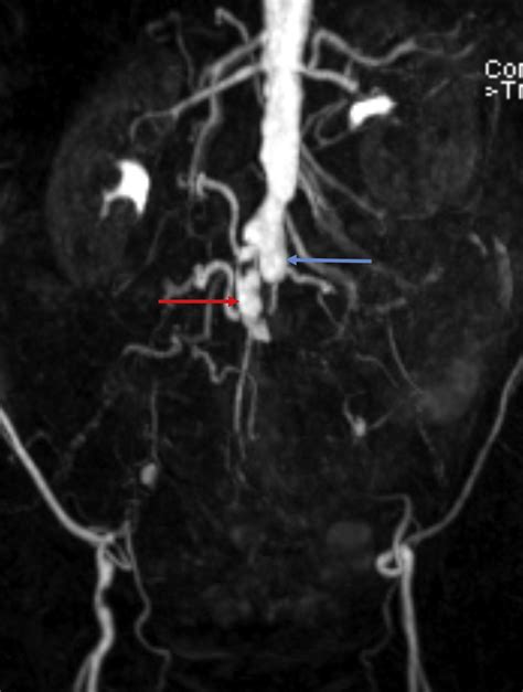 Endovascular Revascularization Of A Chronic Occluded Aortobifemoral