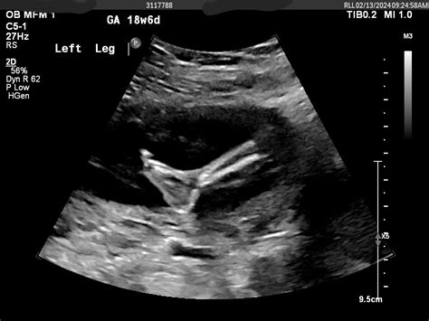 Lets See Our Week Ultrasounds July Babies Forums What