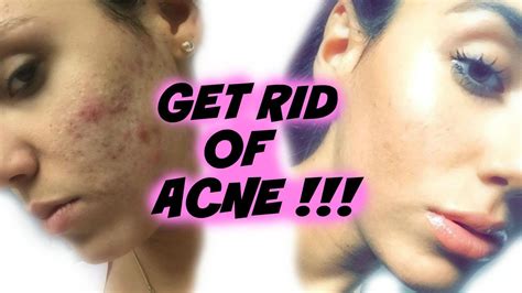 How To Get Rid Of Acne Fast Easy Youtube