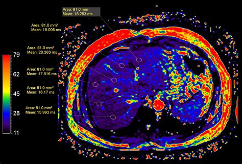 Fatty Liver With Mr Elastography Philips Mr Body Map