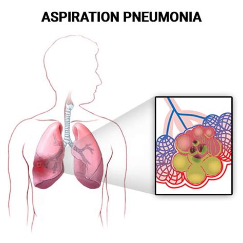 Aspiration Pneumonia