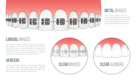 Different Types of Braces