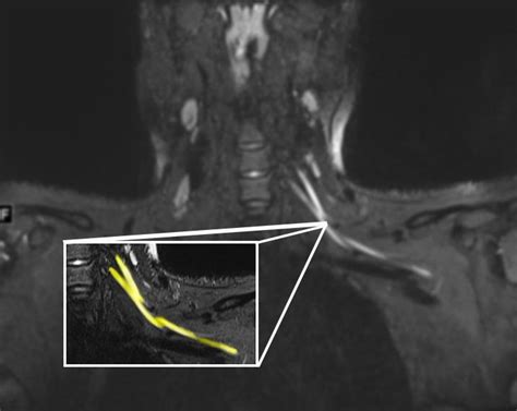 Mri Shows Nerve Damage In Neck Image Eurekalert Science News Releases